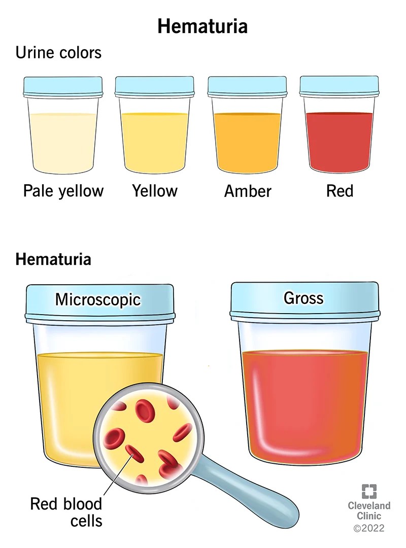 What bloody urine, abnormal scrotum, enlarged breast, say about your