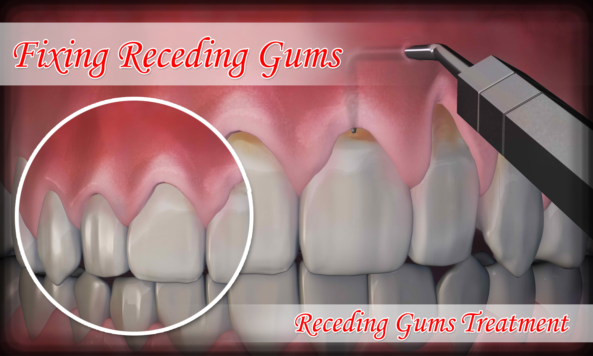 Gum Rejuvenation Port Jefferson Smiles
