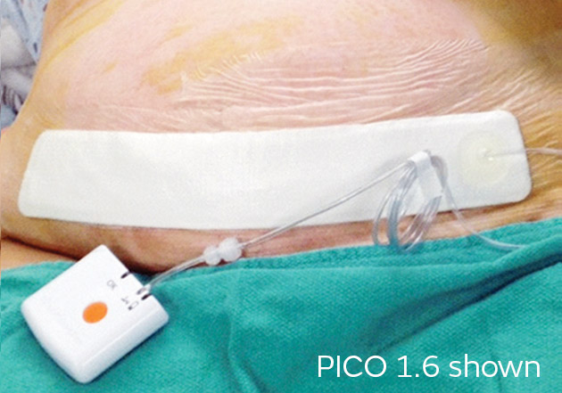 Pico Wound Dressing Smith And Nephew Buying Online | www.oceanproperty