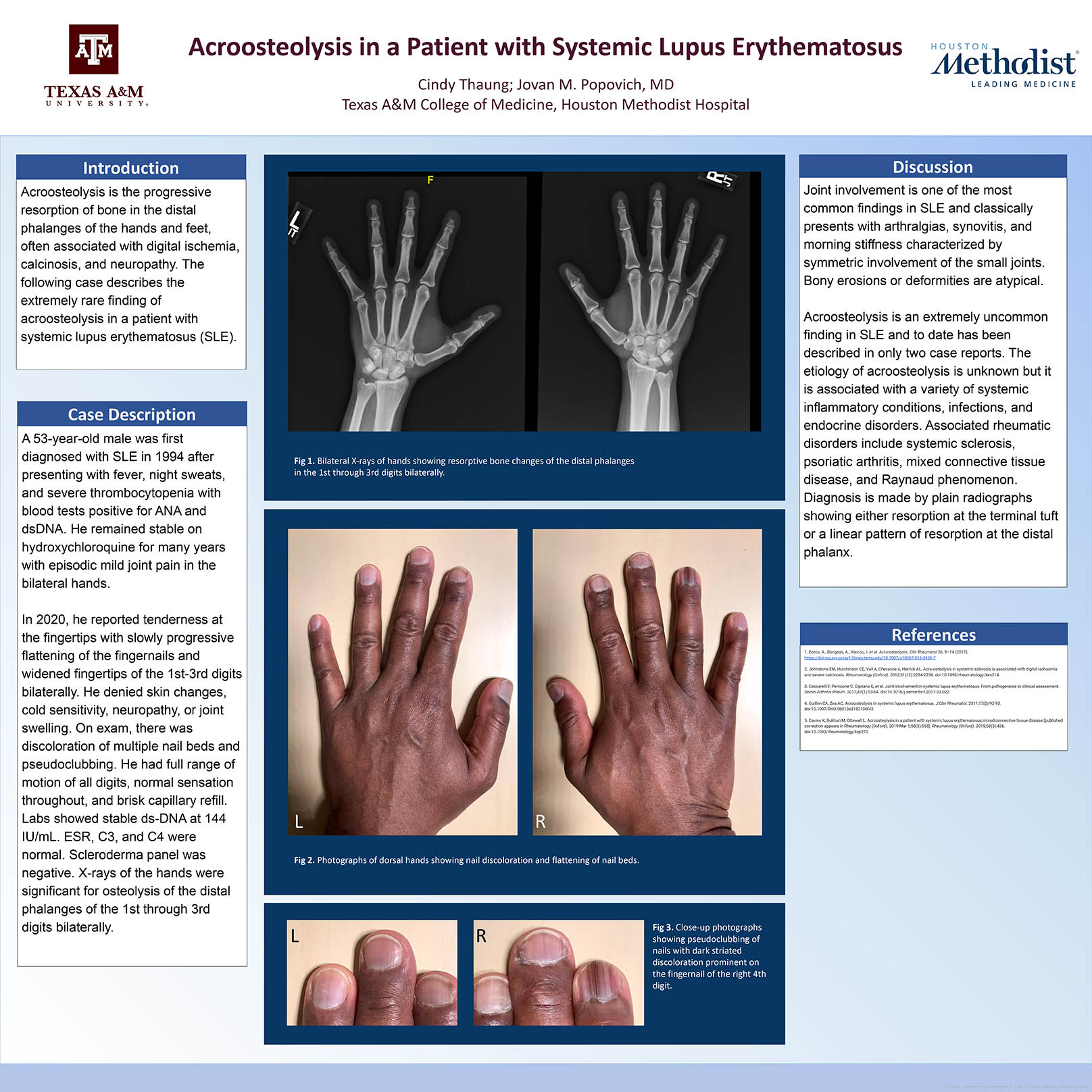 Acroosteolysis in a Patient with Systemic Lupus Erythematosus