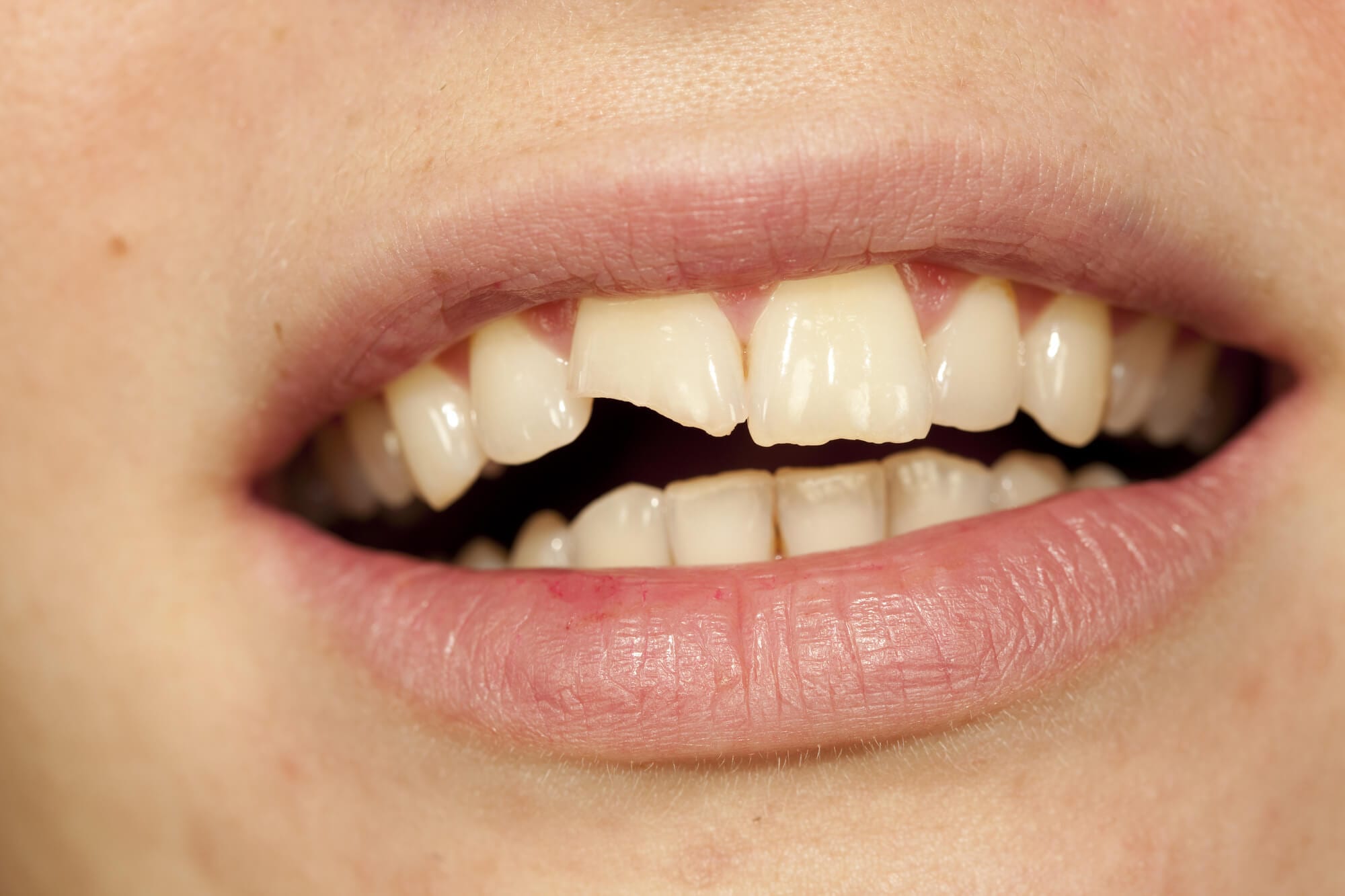 What does it mean to dream that your teeth fall out?
