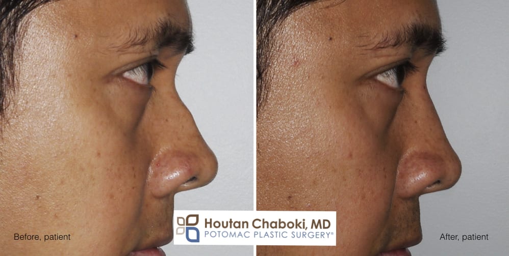 Augmentation Rhinoplasty without Breaking the Nose