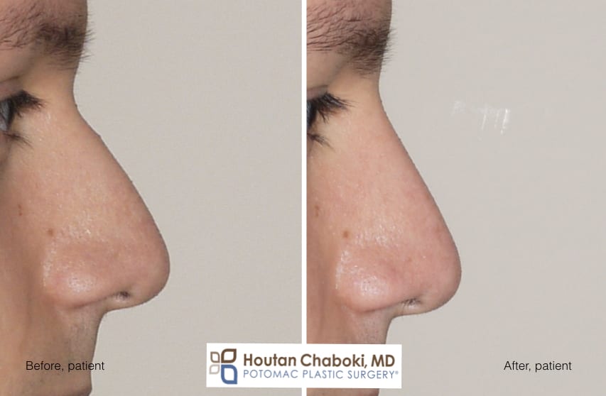 Augmentation Rhinoplasty without Breaking the Nose
