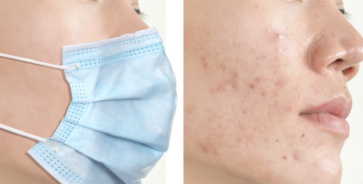 Protect Your Skin From Acne Caused By Face Mask With Simple Remedies