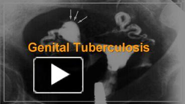 Ppt Genital Tuberculosis Powerpoint Presentation Free To