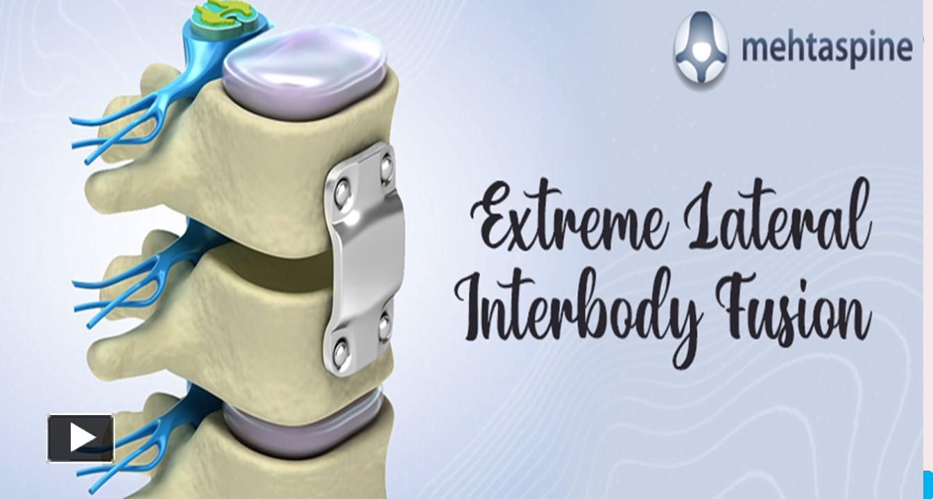 PPT Lateral InterBody Fusion Nerve Pain After XLIF Surgery PowerPoint presentation free