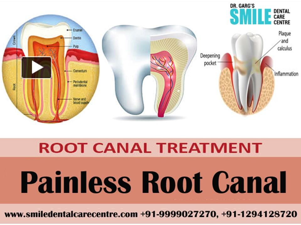 PPT Can Painless Root Canal Treatment procedure be performed in India