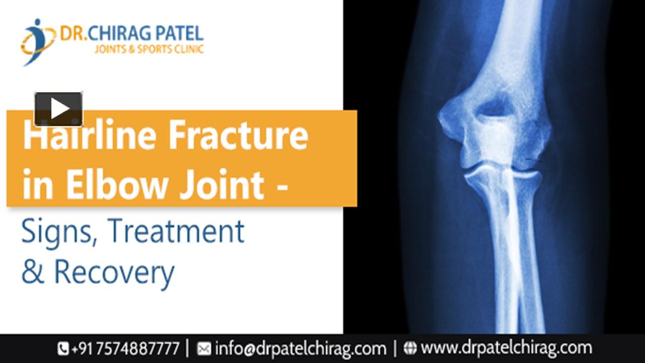 PPT Understanding Hairline Fractures in the Elbow Joint Dr. Chirag
