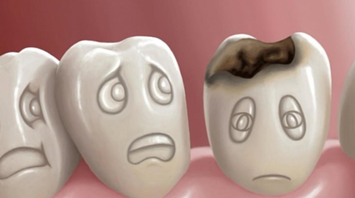 Cost Of Cement Filling In Teeth TeethWalls