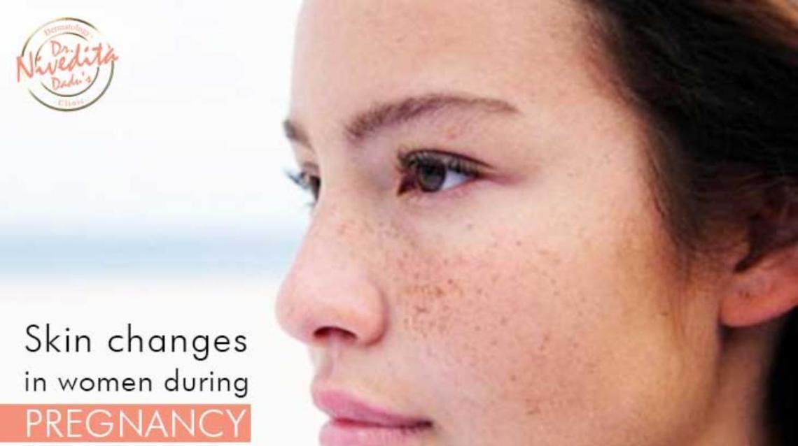Skin Changes in Women During Pregnancy
