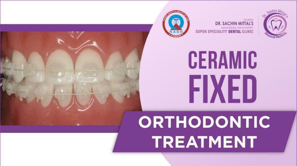 Ceramic Braces Pros and Cons Ceramic Braces Cost in India Ceramic