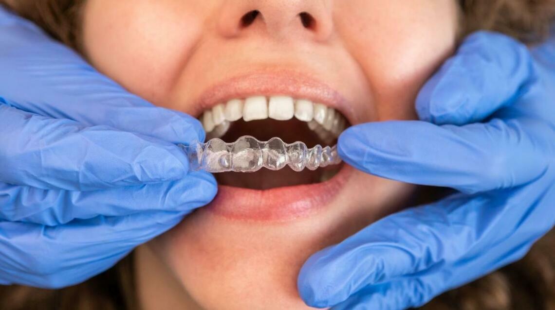 Clear Aligners Cost in India । Dr. Sachin Mittal