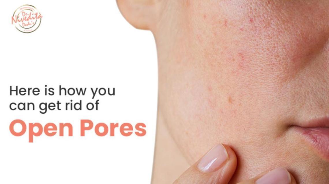 Here Is How You Can Get Rid of Open Pores