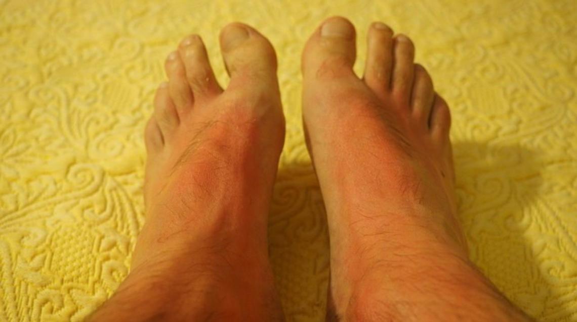 Burning Pain or Tingling Sensation in Hands or feet