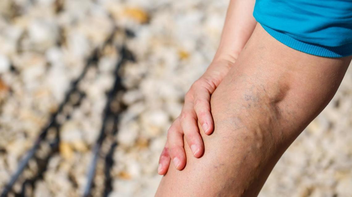 ***Best Home Remedies to Treat Hamstring Injury***