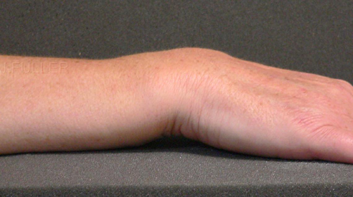 Classical Dinner Fork Deformity of Colles' Fracture of Wrist