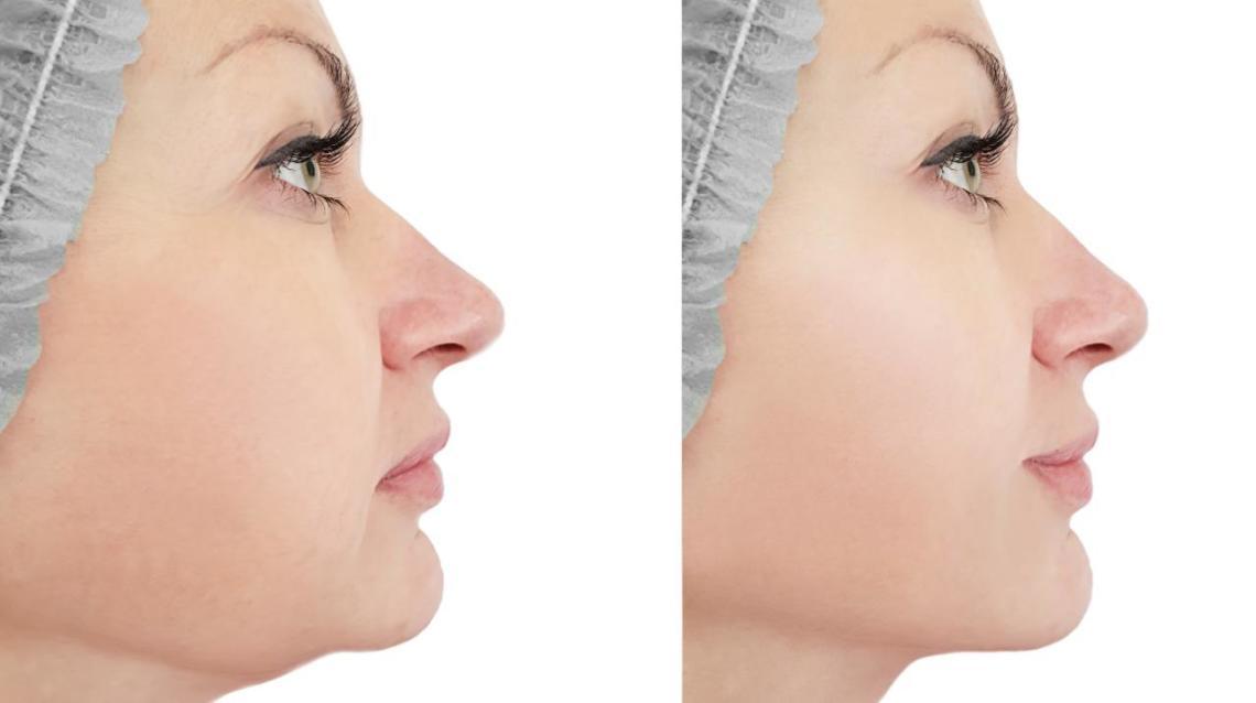 Double Chin Causes and Treatments