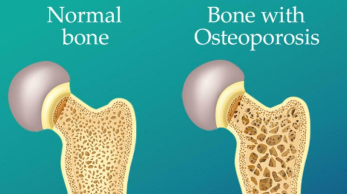 Osteoporosis
