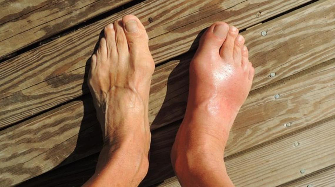 Uric Acid and Joint Problems Facts and Myths