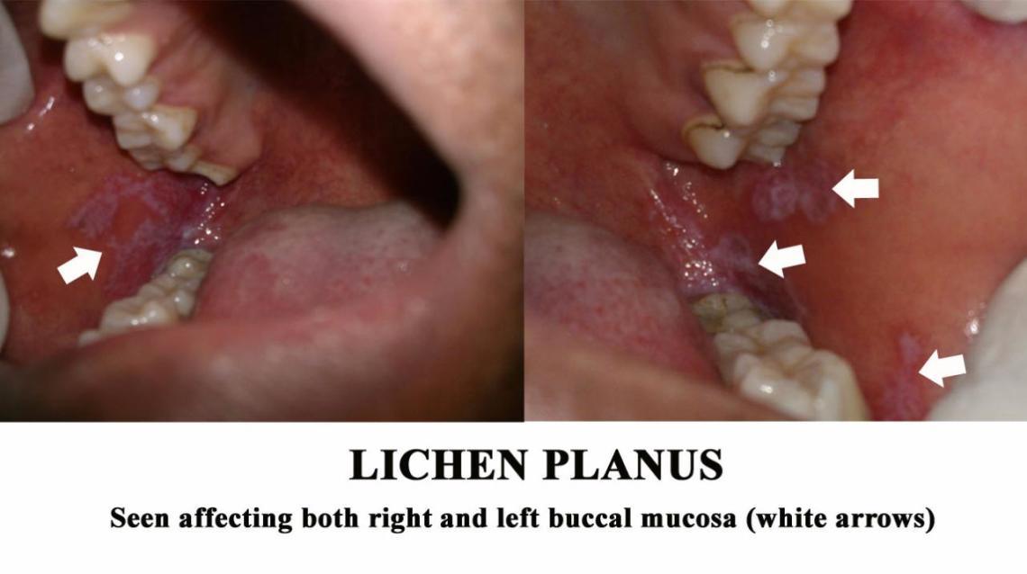 Noticed Red & White Lesions in Your Mouth? You Might Have Lichen Planus!