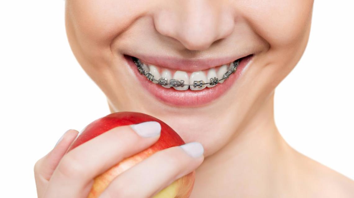 Instructions After Getting Braces