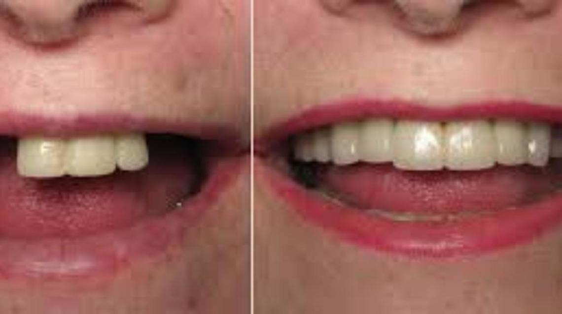 Get Your Missing Teeth Replaced