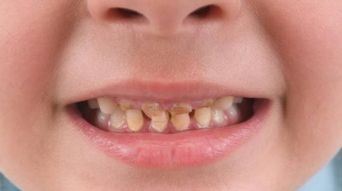 Dental Caries in Deciduous Teeth