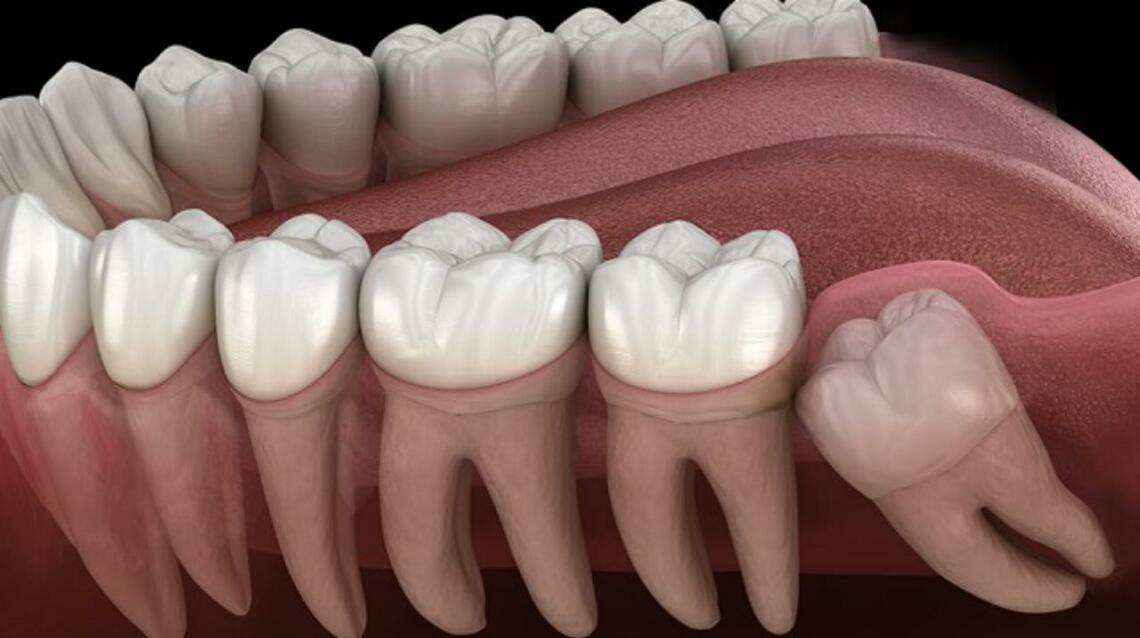 Cost of Wisdom Tooth Removal in Seawood
