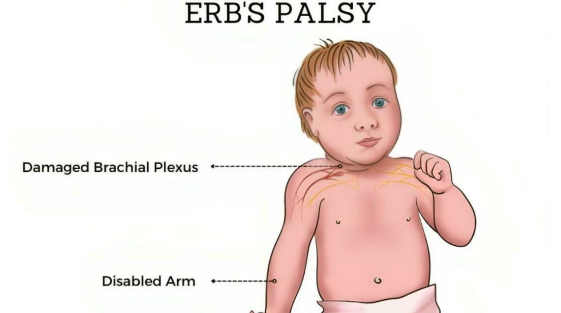 Understanding Erb's Palsy and the Role of Physiotherapy in Treatment