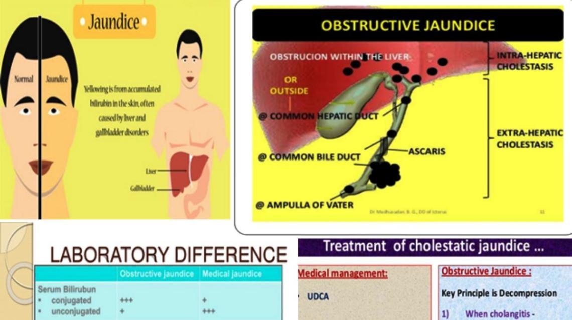 Jaundice Should I Consult Physician or Surgeon?