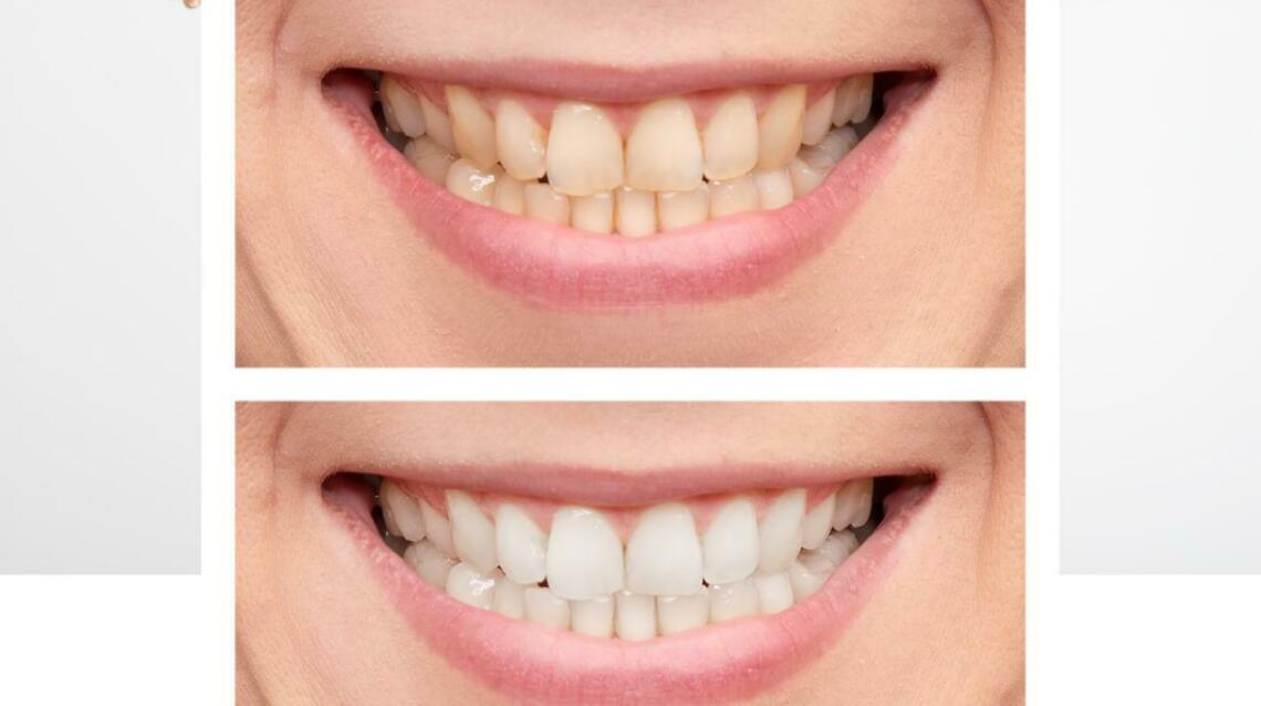 5 Simple Home Remedies to Keep Your Teeth White