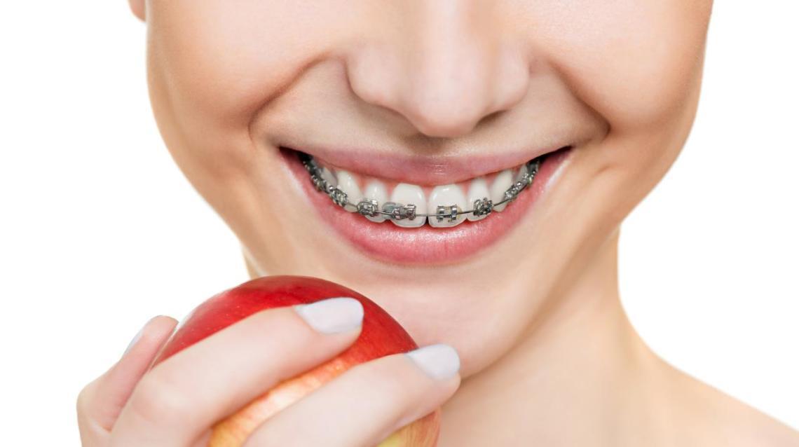 What to Do After Getting Braces?