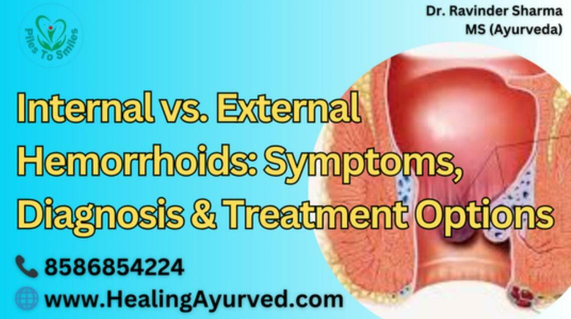 Internal vs. External Hemorrhoids Symptoms, Diagnosis & Treatment Options