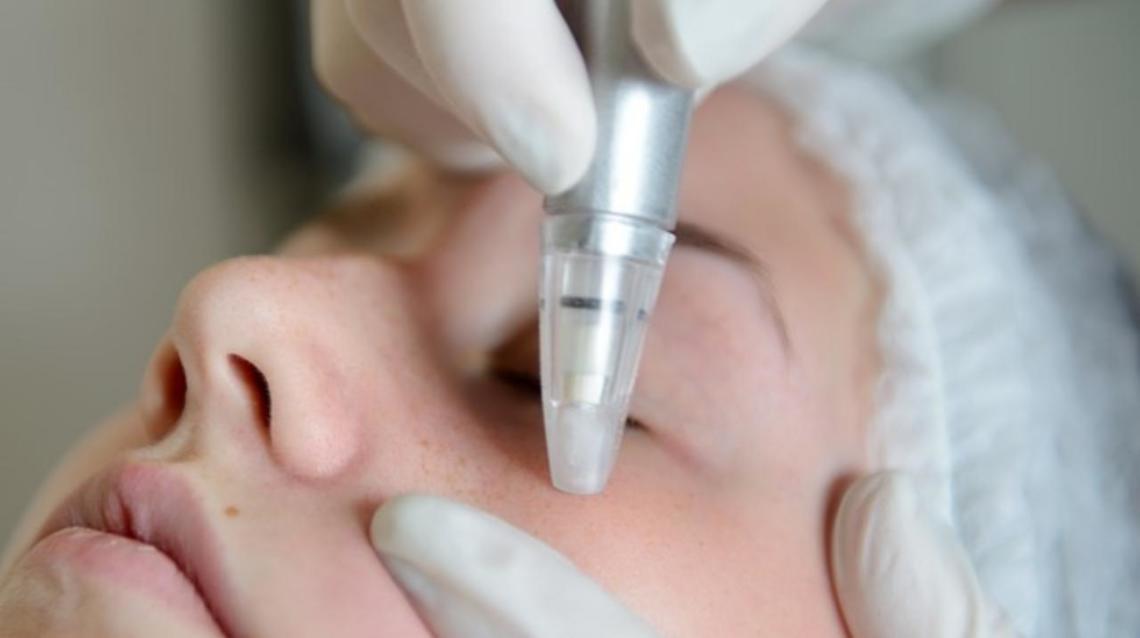 Microdermabrasion for Face Glow