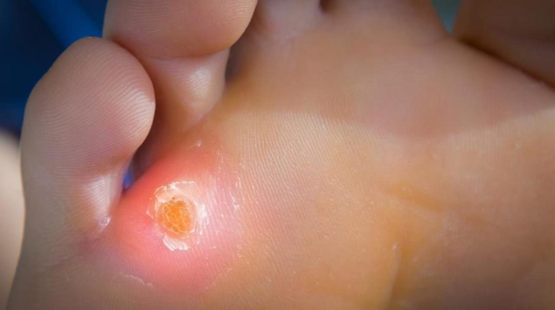 All About Corn in Foot