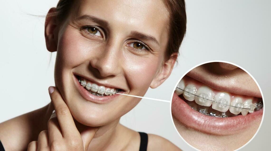 Braces Hack