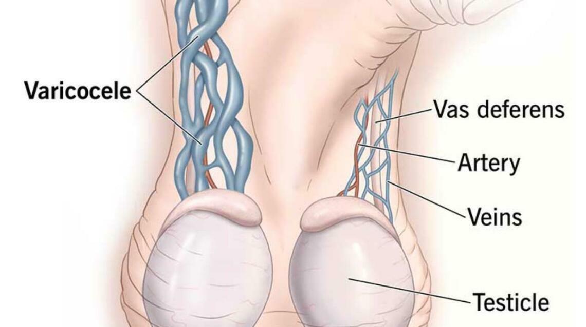 Varicocele