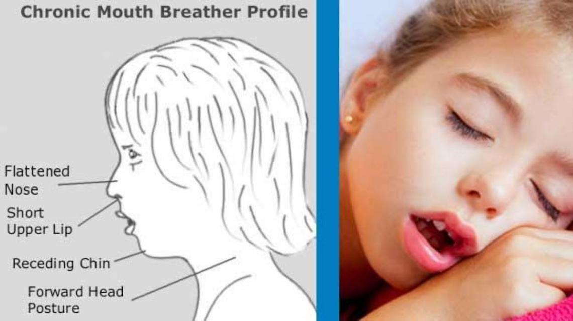 Does Mouth Breathing Send a Red Signal
