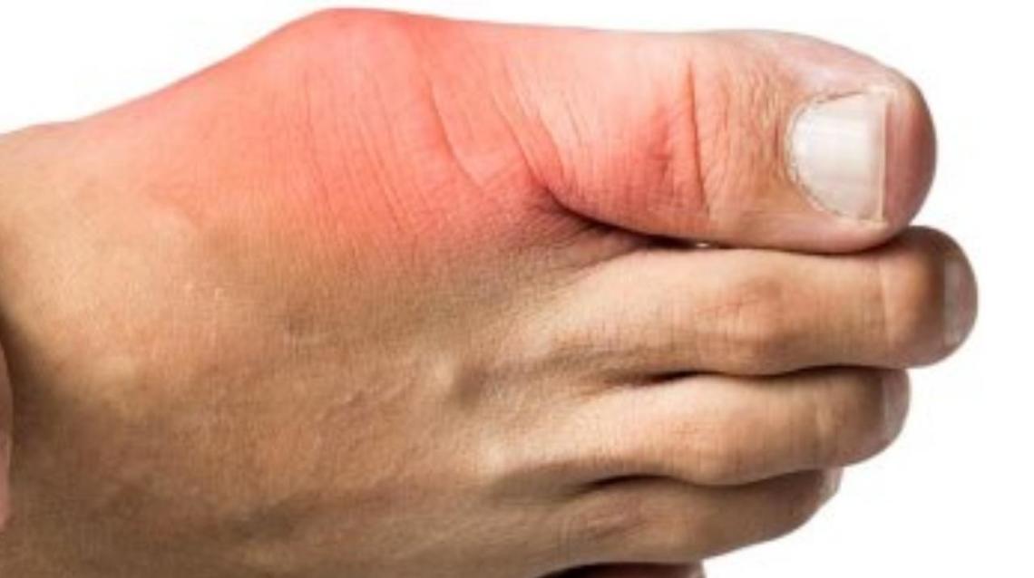 Understanding Gout The Disease of Kings