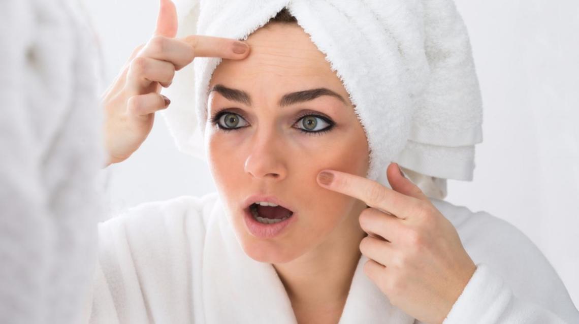Think You're Safe From Acne Now That You're 30? Think Again!