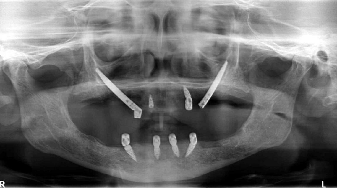 Learn About Black Fungus and Zygomatic Implants