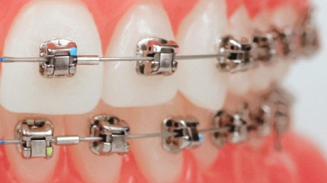 What Are Damon Braces?
