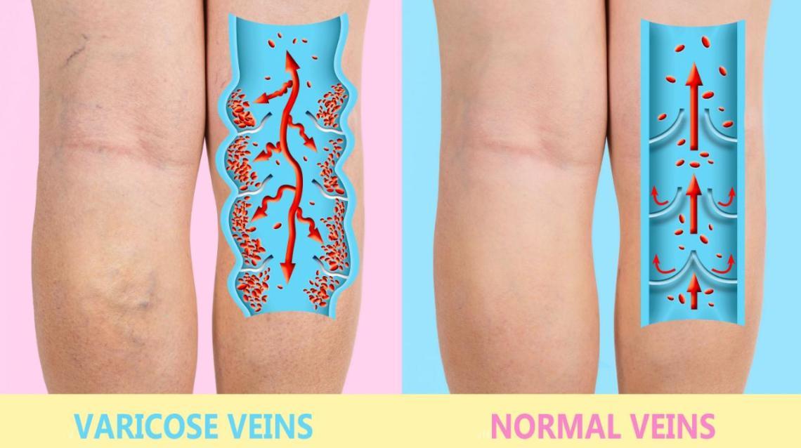Know About Varicose Veins and It's Physiotherapy