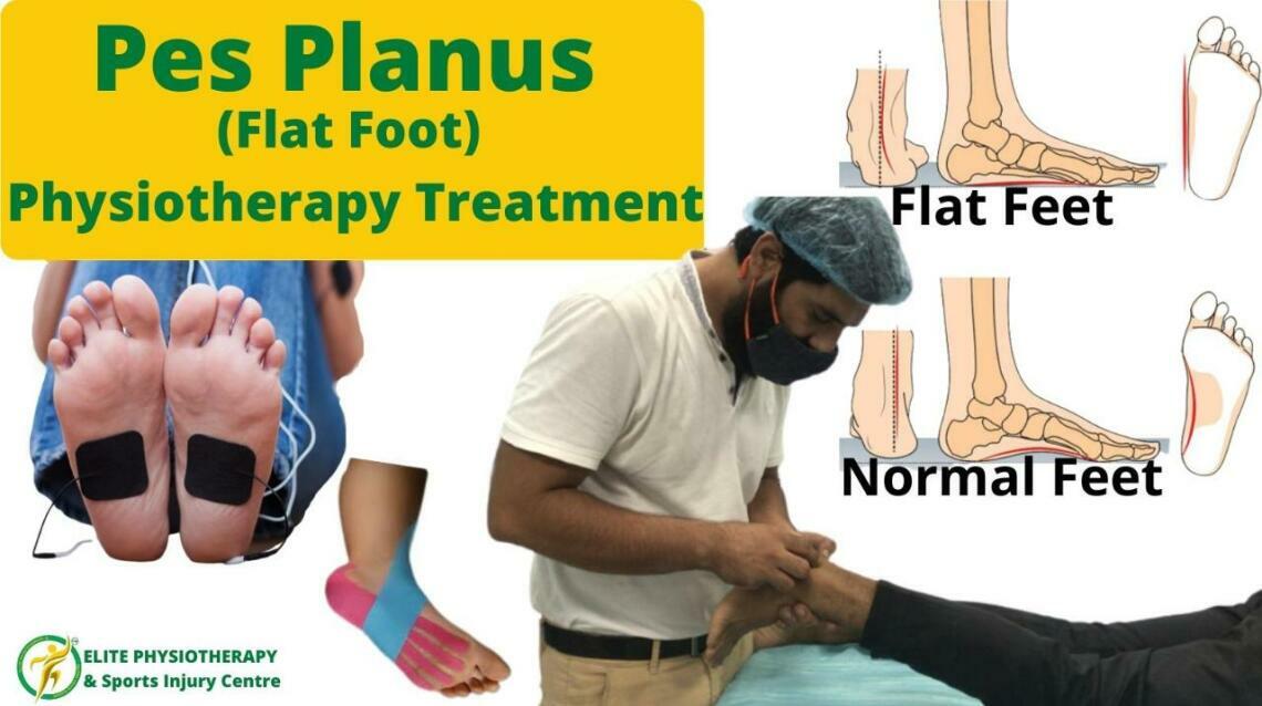 Pes Planus (Flat Foot) Physiotherapy Treatment