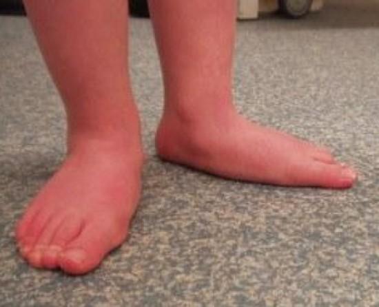 When Do You Worry About Your Children’s Foot Condition? Orthofit