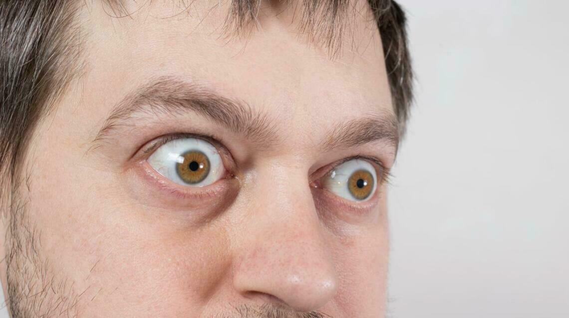 All About Bulging Eyes