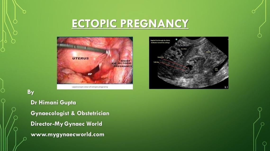 Ectopic Pregnancya Devastating of Pregnancy,update2.2.19,why