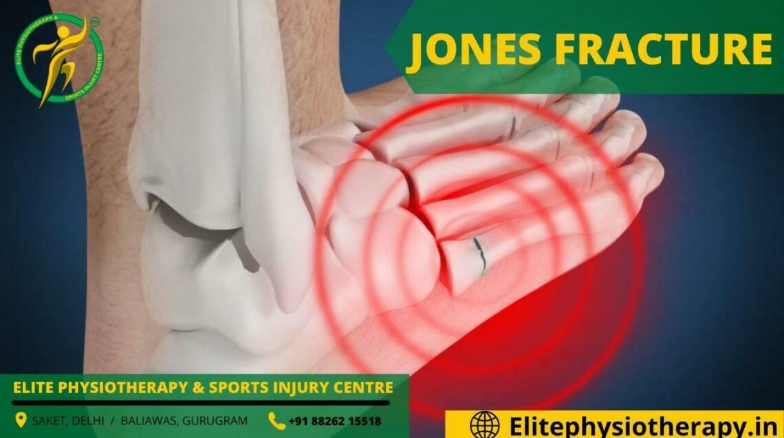Jones Fracture