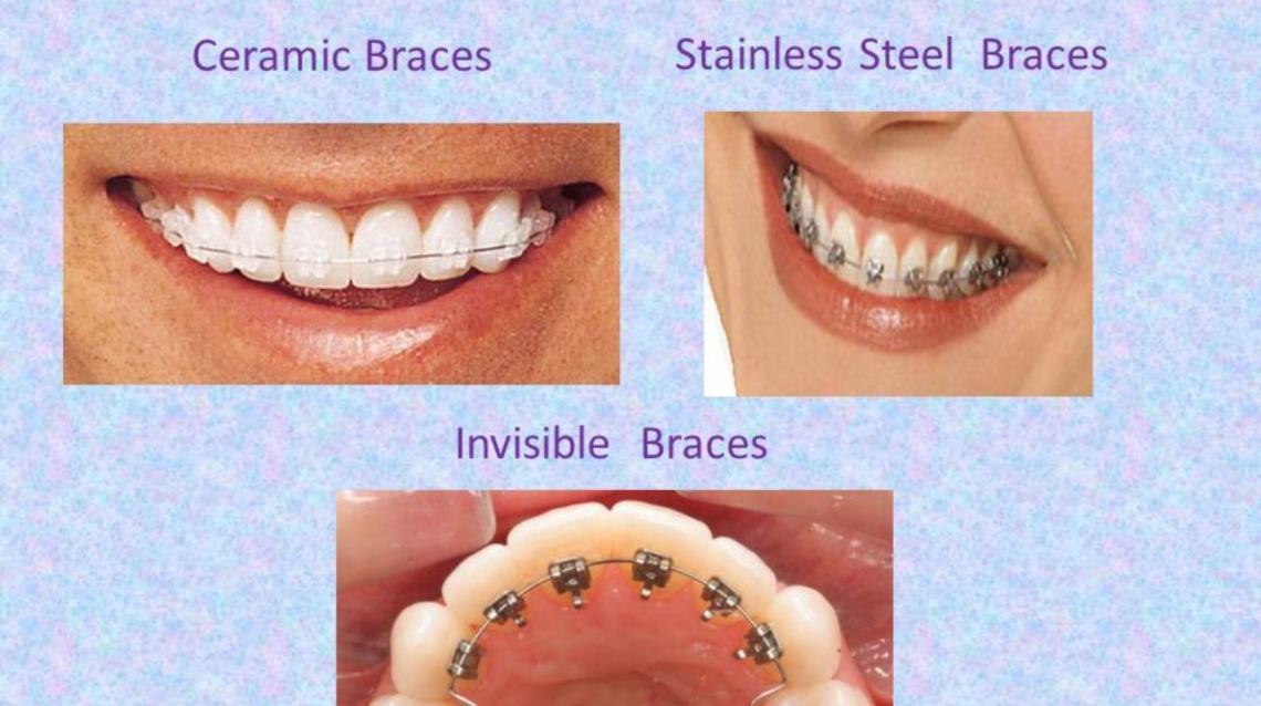 Fixed Orthodontic Appliances.