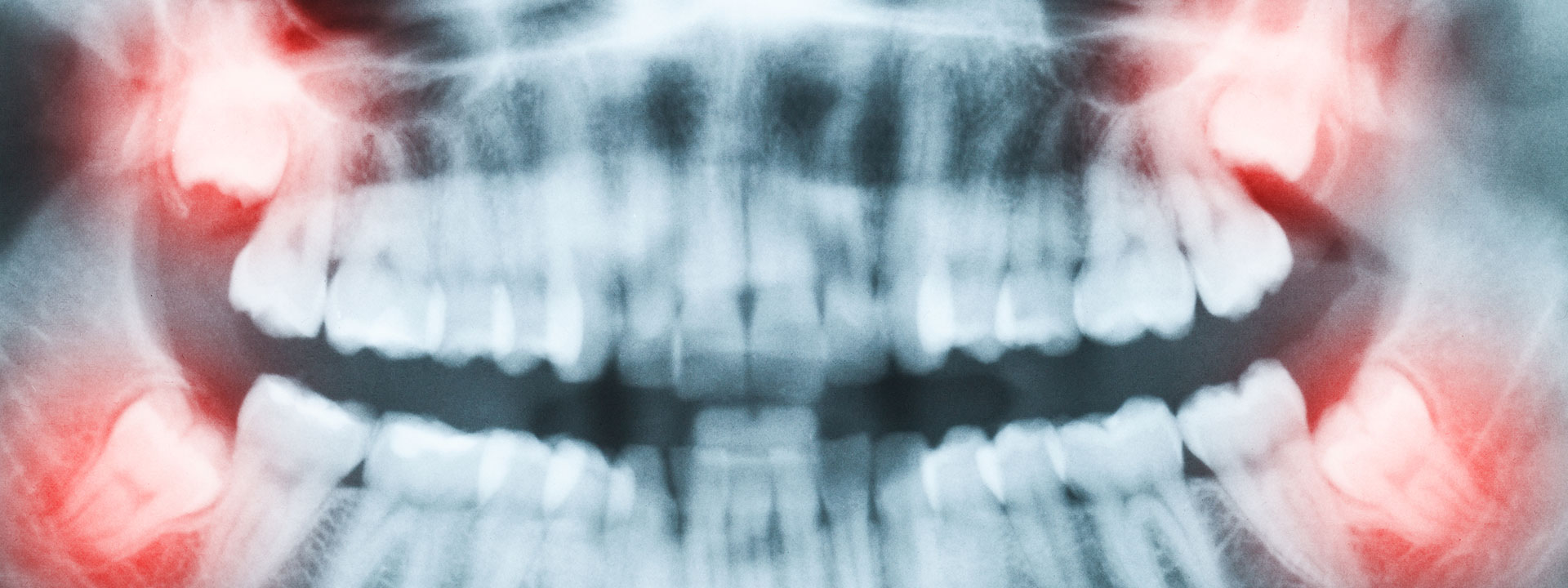 Wisdom Teeth Extraction Ocean Dental Group